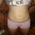 11 days post-op!