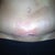 POD 24.  Here is the part of my incision that is not closed yet.  Note the red area that has come back under my BB.