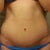 Scars 11 weeks po