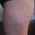 close up left lateral thigh