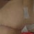 Scar 4 weeks post op