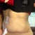 Scar 4 weeks post op
