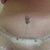 3 days post op