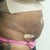 48 hours after Smart Lipo - Side