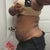 5 days after Smart Lipo - Side