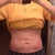 Had my sides (moving towards bellybutton) done today. 3 weeks and 5 days post upper stomach. You can see it's gone down a little.