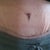 PO Day 16 - scar.  What is with the puckering???!!