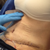 3 days post op