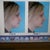 My before image and morph from Dr Shah