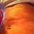 2 wks post op.  Divots, unevenness.