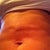 2 wks post op.  Divots and unevenness.