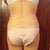 I had lipo contouring on my hips but not the full "flanks" lipo