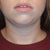 1 Week Post - Front (Swelling is all under chin area and jowl)