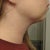 1 Week Post - Right Side (See swelling in jowl area)