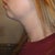 1 Week Post - Left Side (See swelling in jowl area)