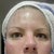 2nd procedure, 1 day after-AM