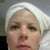 2nd procedure, 2 day's after-AM