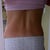 5 years post op