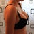 1 Week PO. I still fit in my 36C bra (which was big before)!! Of course it looks a lot different now! Love the cleavage :))