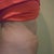Day after procedure