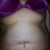 Gained 14 lbs just before surgery in order to take out as much as possible