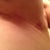 Left scar 2 weeks