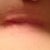 Right scar 2 weeks