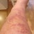 Day 7 - side of one leg