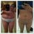 this is my before and after pic, the one on the left is 2 days before surgery, the one on the right is 3 months post op.. it looks like i have a lil bit of a waist now!