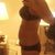 11 days post-op side