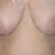 Breast Reduction Community Photo