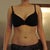 Liposuction Community Photo