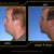 Neck Lift Community Photo