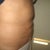 Liposuction Community Photo