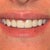 Porcelain Veneers Community Photo