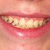 Zoom Whitening Community Photo