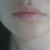 Juvederm Community Photo
