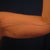 Liposuction Community Photo