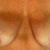 Breast Lift Community Photo