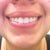 Zoom Whitening Community Photo