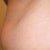 CoolSculpting Community Photo