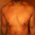 Male Tummy Tuck Community Photo