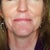 Juvederm Community Photo