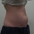 CoolSculpting Community Photo