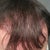 Hair Transplant Community Photo