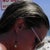 Chin Liposuction Community Photo