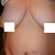 Panniculectomy Community Photo