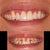 Porcelain Veneers Community Photo