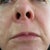 Lip Lift Community Photo