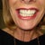 Porcelain Veneers Community Photo